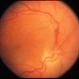 Complications of ARN